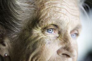 bruising in seniors